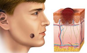 Базалиома кожи лица: симптомы, лечение народными средствами и удаление