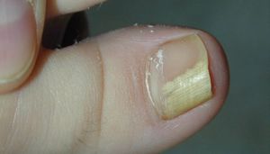 Дрожжевой грибок на коже и ногтях у женщин, мужчин и детей: симптомы и лечение
