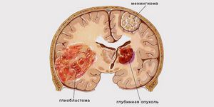 Глиобластома головного мозга: степени и симптомы, причины и лечение опухоли