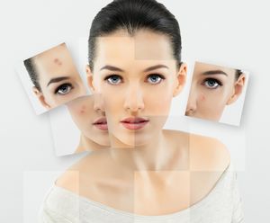 Химическая чистка лица — ваш путь к идеальной коже!