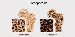 Как лечить остеопороз суставов и костей у женщин в домашних условиях