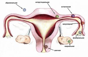 Как проявляется внематочная беременность?