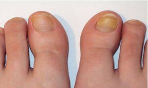 Как вылечить грибок ногтей на ногах?