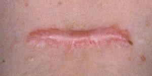 Келоидный рубец: причины образования, лечение и удаление шрамов