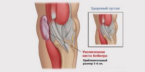 Киста бейкера коленного сустава: причины, народное лечение и операция
