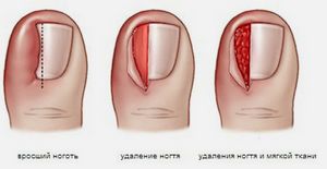 Коррекция вросшего ногтя: методы лечения с ценами в москве (хирургическое, лазерно, скобами или пластинами)