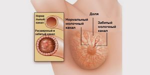 Лактостаз у кормящей матери: симптомы и лечение застоя молока в груди