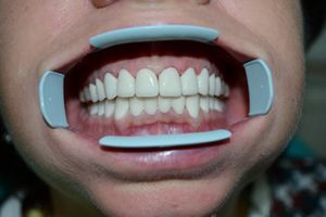 Методы полировки и отбеливания зубов