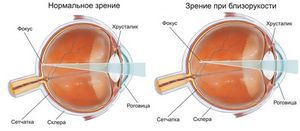 Миопия слабой степени у детей, взрослых и при беременности: как лечить глаза