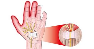 Онемение пальцев левой руки: мизинца, безымянного, большого и среднего