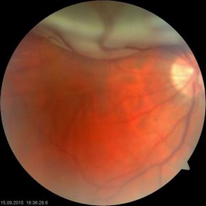 Отслойка сетчатки (retinal detachment )