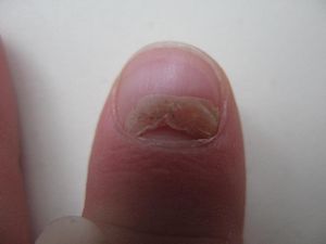 Почему грызут ногти?