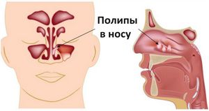 Полипы в носу - причины возникновения и варианты лечения