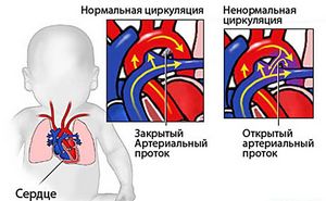 Порок сердца: симптомы и лечение у детей врожденного и приобретенного