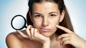 Проблемная кожа — как бороться с угрями?
