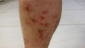 Рожистое воспаление кожи ноги и руки: симптомы и лечение в домашних условиях