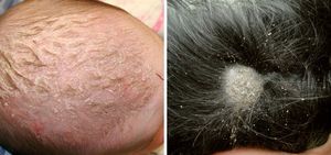 Себорея кожи головы: причины и симптомы жирной, сухой и смешанной, как лечить в домашних условиях