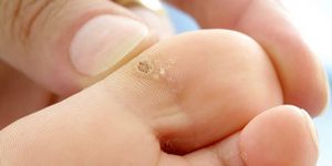 Сухая мозоль на пальце ноги - причины появления, способы и средства лечения, рецепты