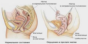 Выпадение матки у женщин в пожилом возрасте: лечение и операция шейки